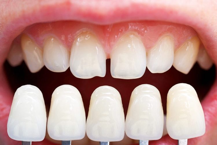 dental veneers