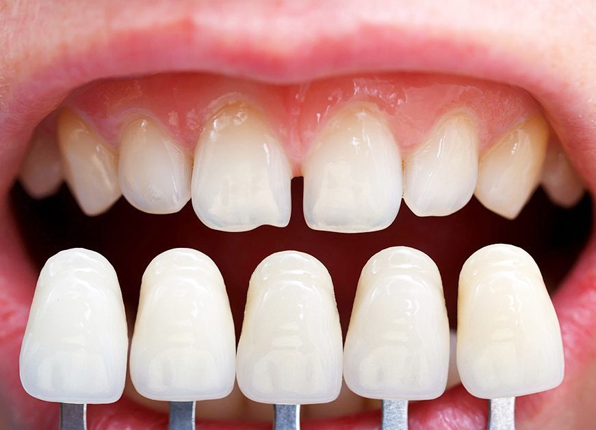 dental veneers