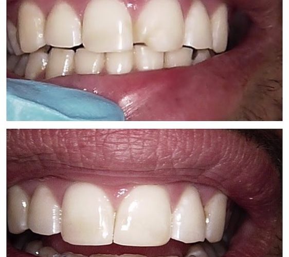 chipped tooth restoration before and after