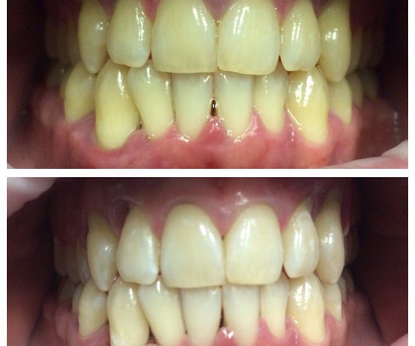 teeth jaw whitening before and after