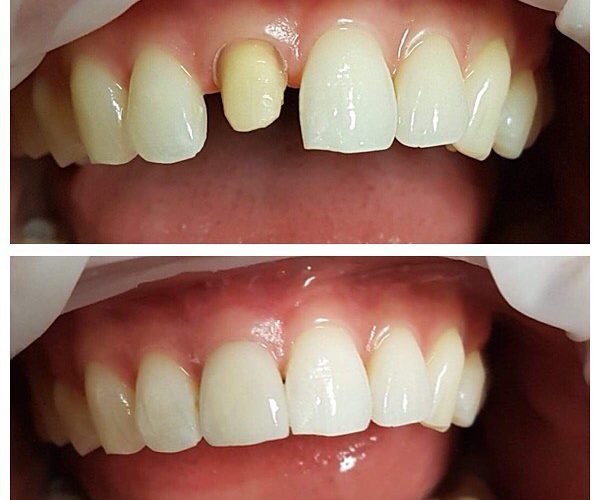 teeth jaw before and after crown procedure