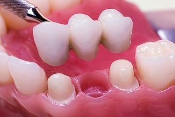 dental bridge