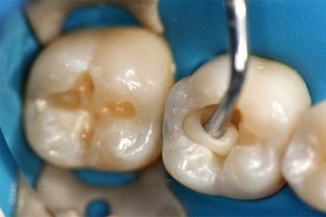 tooth receiving filling